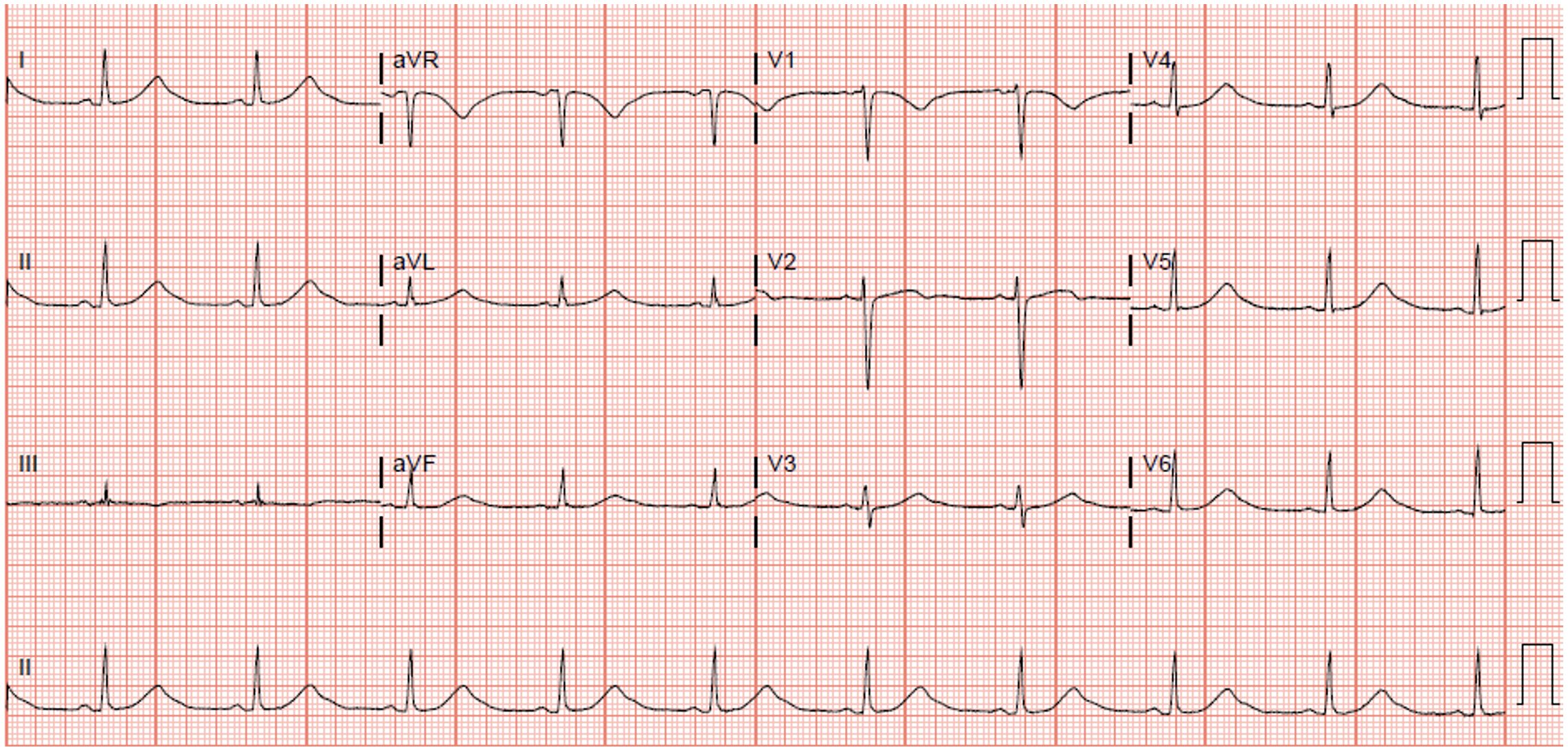 ECG Long QT