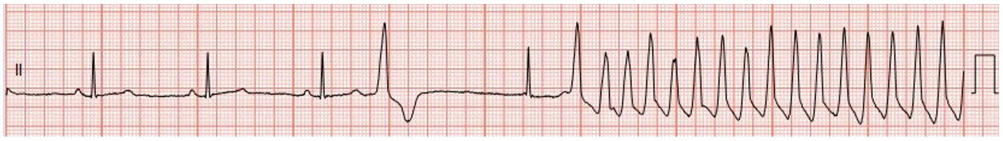 Long qt rhythm