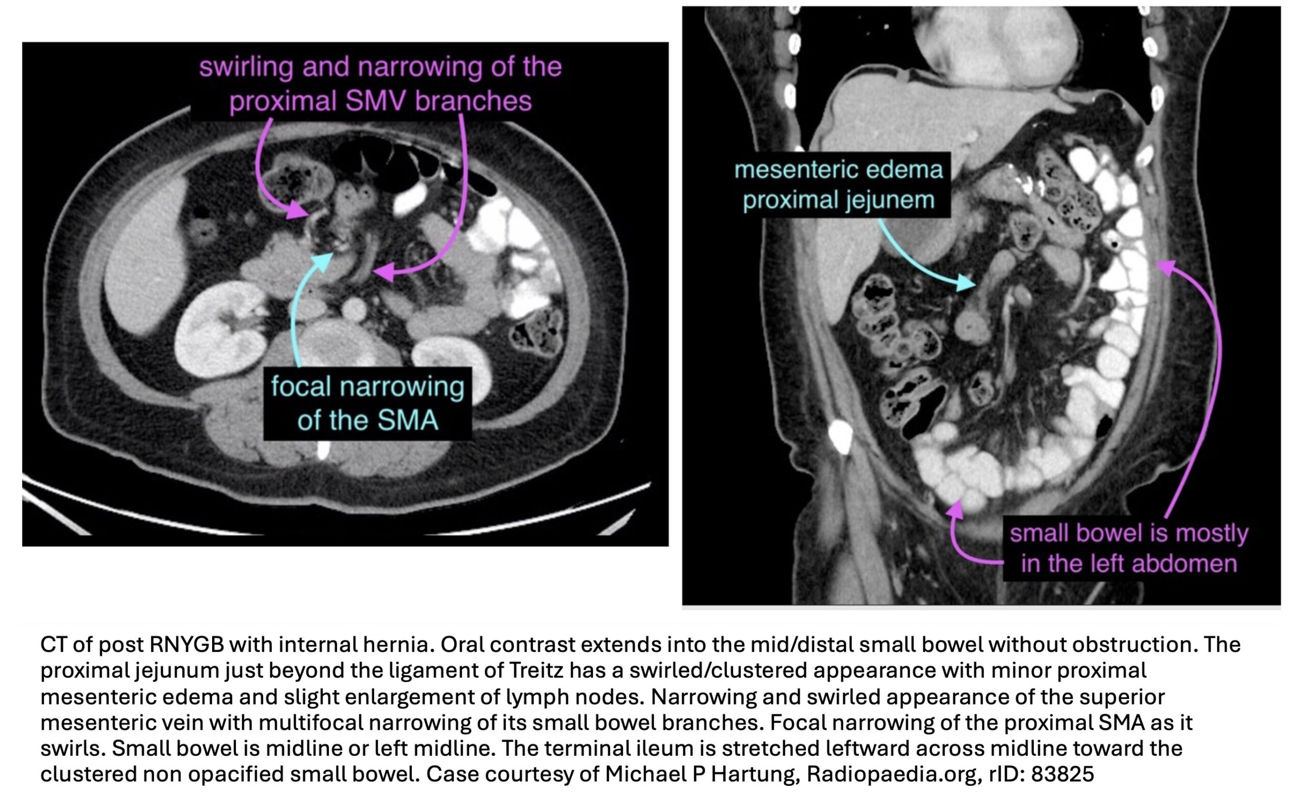 internal hernia 2