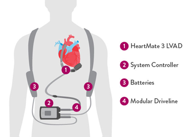 Figure 2 HeartMate 3 LVAD system overview