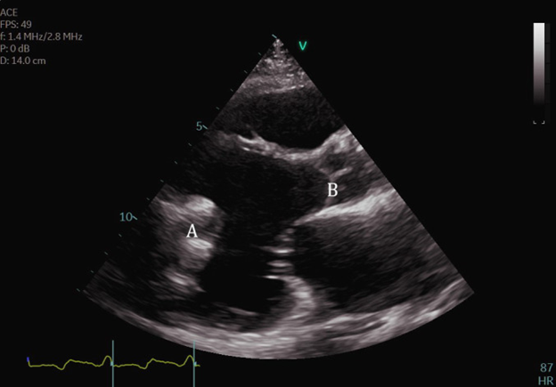 Figure 5 Transthoracic echocardiogram PLAX view demonstrating normal appearing inflow cannula at LV apex (A)