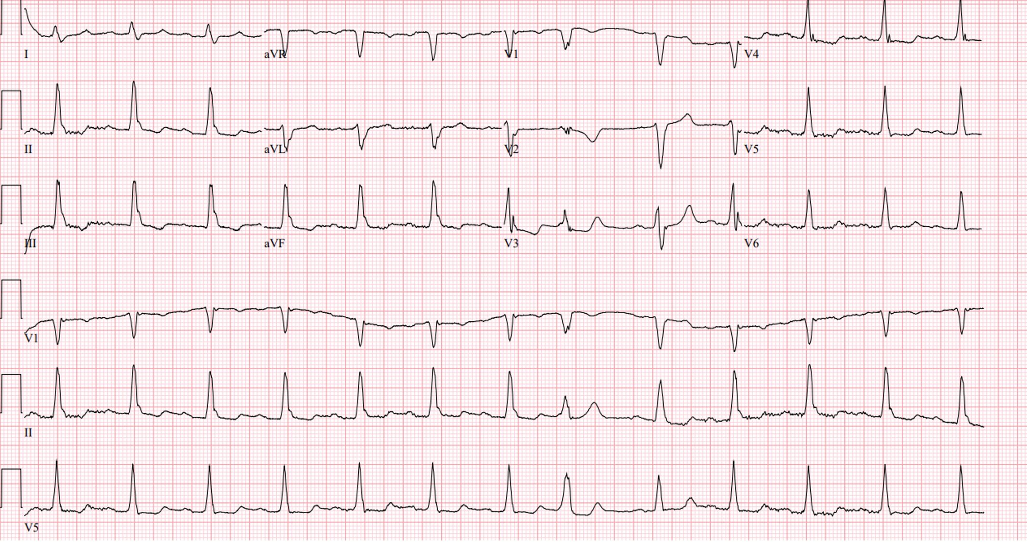 ECG Spine