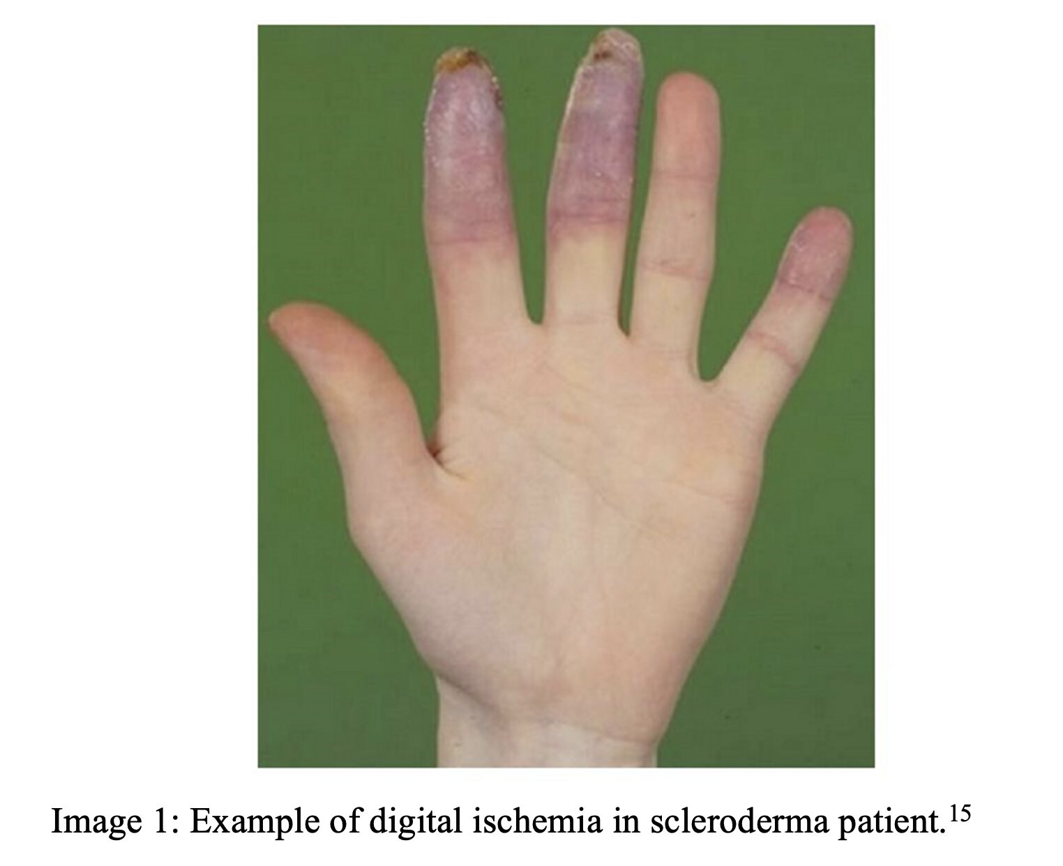 scleroderma 1