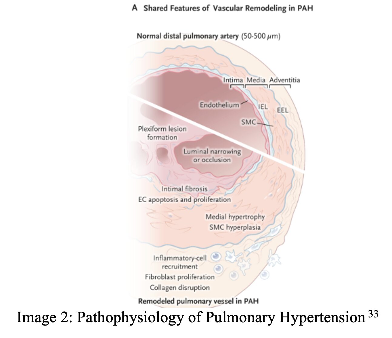 scleroderma 2