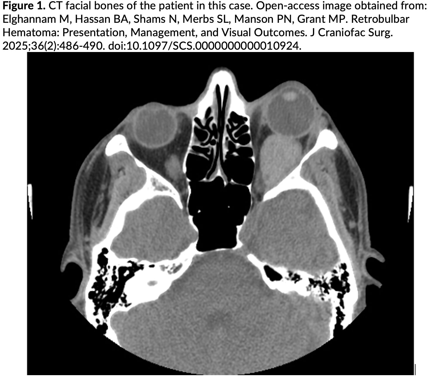retrobulbar hematoma