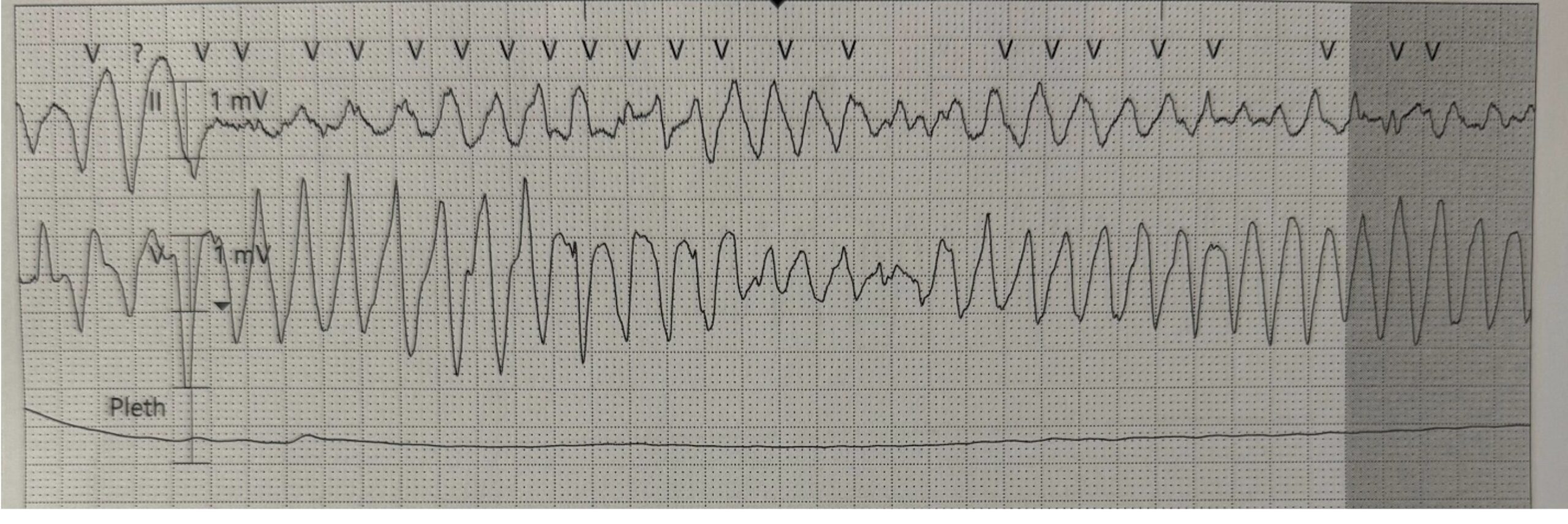 Torsades telemetry