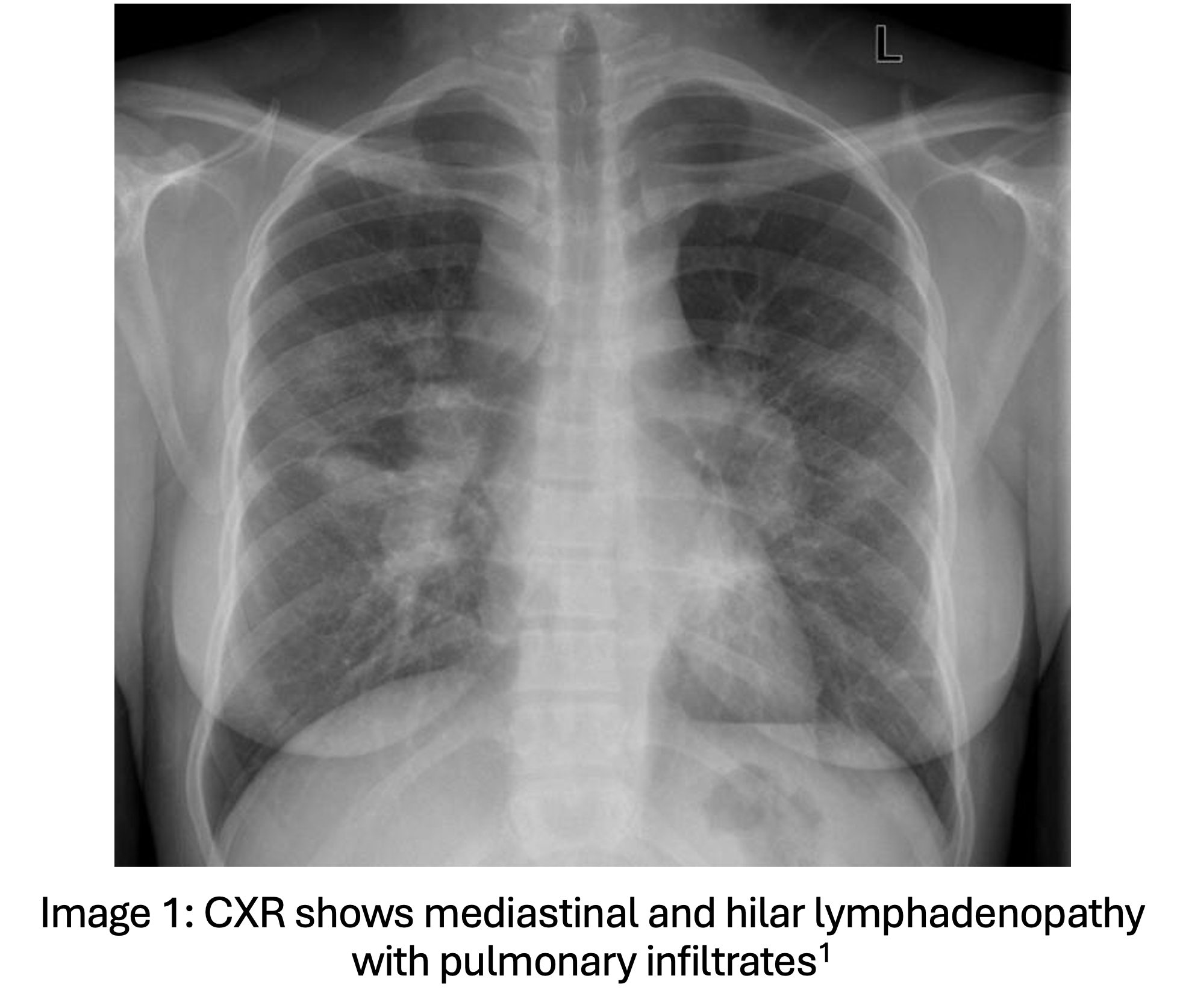 Sarcoid CXR