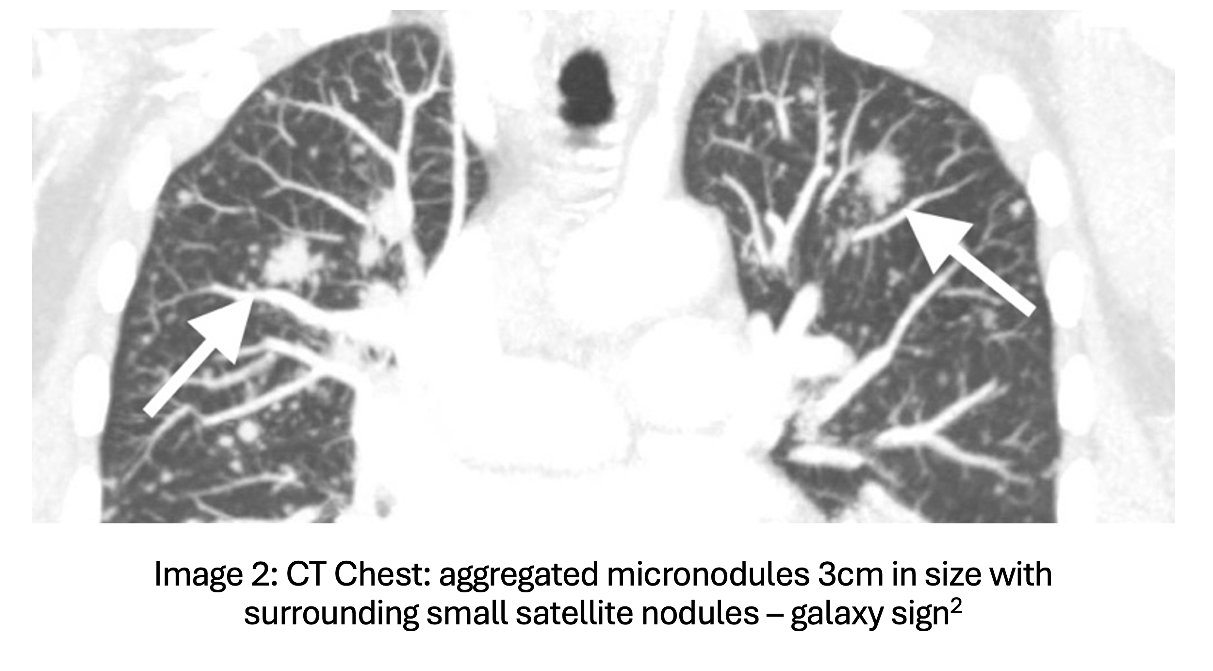 CT sarcoid